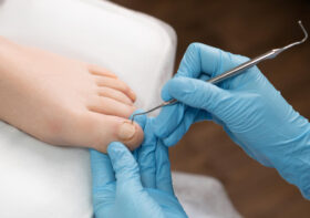 Uszkodzenia płytki paznokcia – przyczyny i możliwe rozwiązania