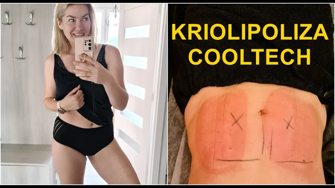 Kriolipoliza brzucha